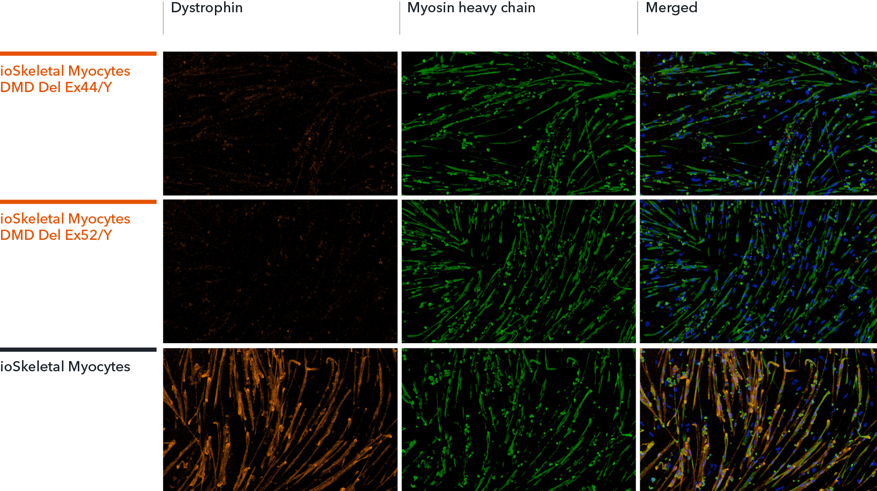  ioSkeletal Myocytes DMD Exon Deletion disease model cells immunocytochemistry shows absence of Dystrophin protein