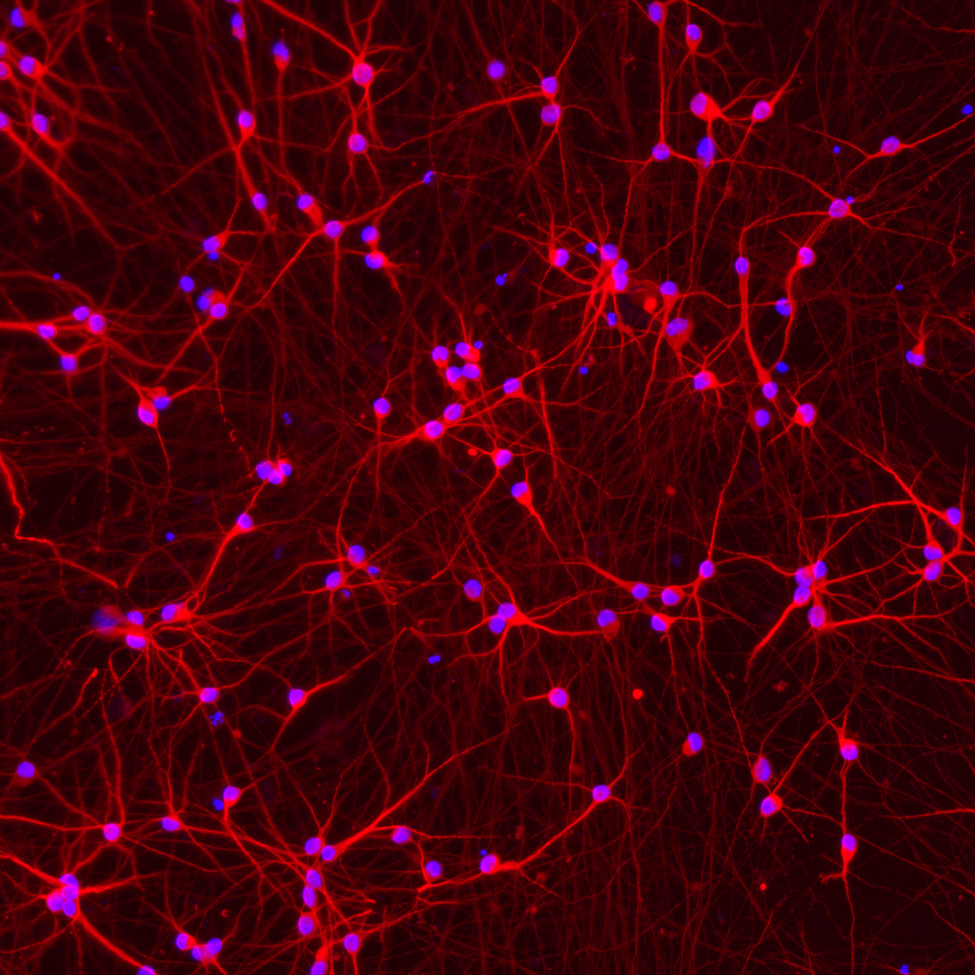 Human iPSC-derived Alzheimer's disease model in glutamatergic neurons