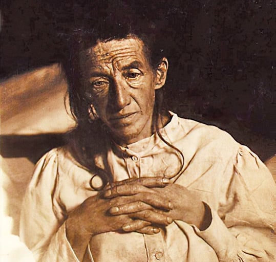 Alios Alzheimer's patient Auguste Deter, the first patient described to have Alzheimer's disease