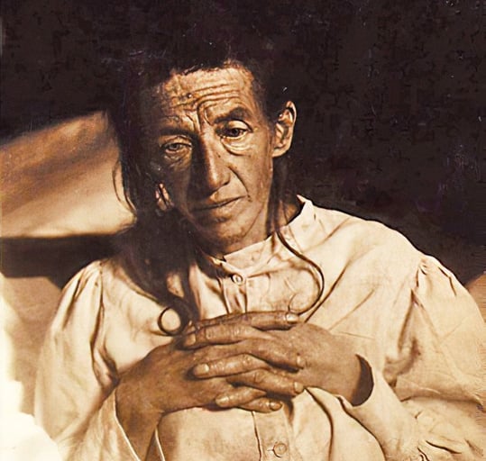 Alios Alzheimer's patient Auguste Deter, the first patient described to have Alzheimer's disease