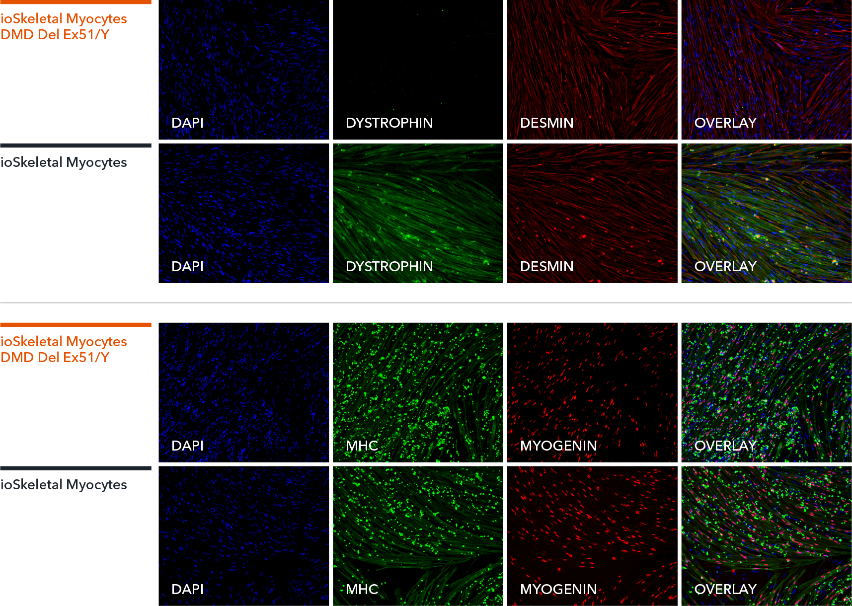 bit.bio iPSC-derived skeletal myocytes DMD Exon 51 deletion ICC shows lack of dystrophin